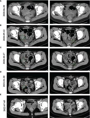 Case report: Long-term clinical benefit of pyrotinib therapy following trastuzumab resistance in HER2-amplification recurrent mucinous ovarian carcinoma